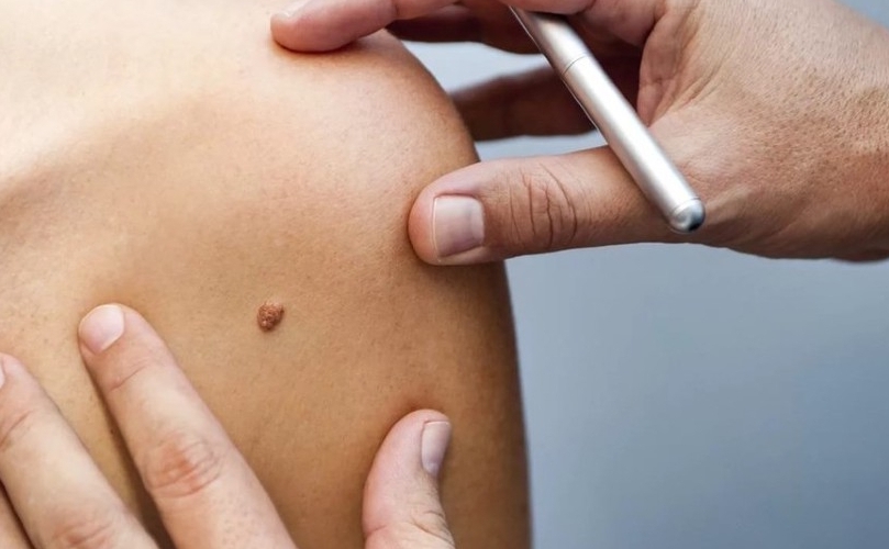 Il nuovo farmaco blocca la crescita del melanoma e delle metastasi