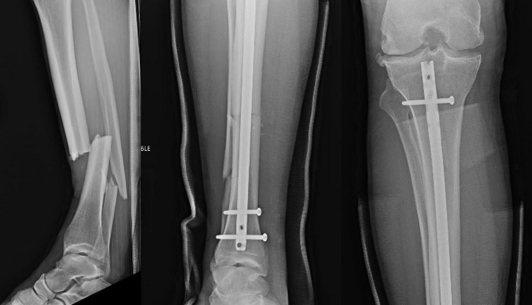Chris Weidman publicou fotos da fratura antes e depois da cirurgia