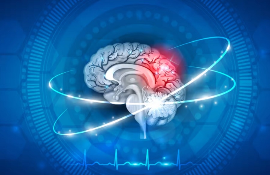 Un risque accru d'accident vasculaire cérébral chez les adultes est associé à un certain groupe sanguin.