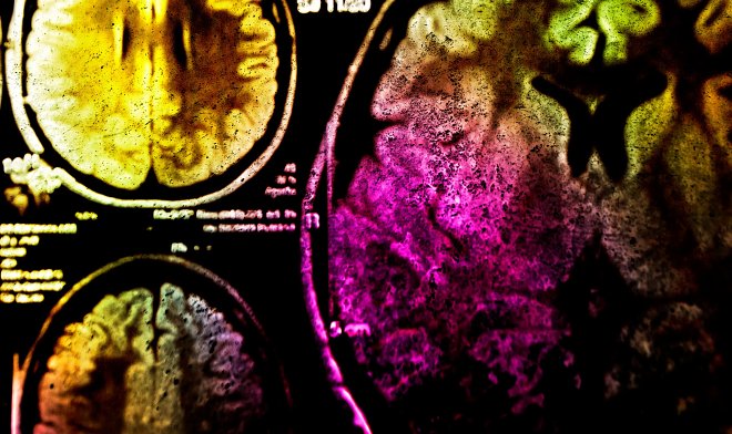 La fotoimmunoterapia potrebbe aiutare a combattere il cancro con la luce