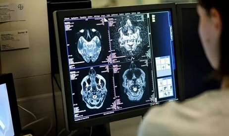 Coronavirus kann das Gehirn ernsthaft schädigen