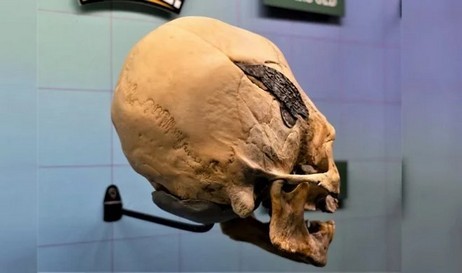 Il teschio peruviano con un complesso impianto di metallo suscita polemiche tra gli scienziati